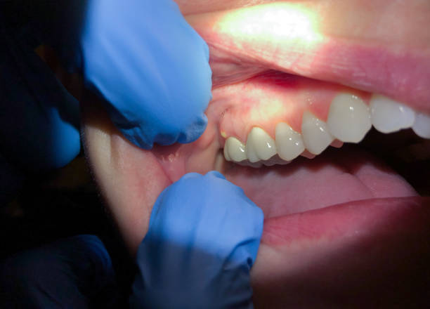Best Emergency Tooth Extraction in Edwardsville, PA